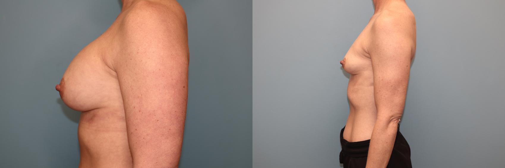 Before & After Breast Implant Removal with no Lift Case 42 Left Side View in Oklahoma City, Tulsa, Norman, OK