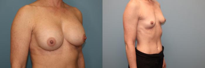Before & After Breast Implant Removal with no Lift Case 42 Right Oblique View in Oklahoma City, Tulsa, Norman, OK