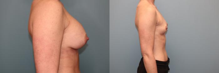 Before & After Breast Implant Removal with no Lift Case 42 Right Side View in Oklahoma City, Tulsa, Norman, OK