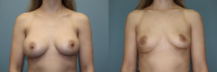 Before & After Breast Implant Removal with no Lift Case 45 Front View in Oklahoma City, Tulsa, Norman, OK
