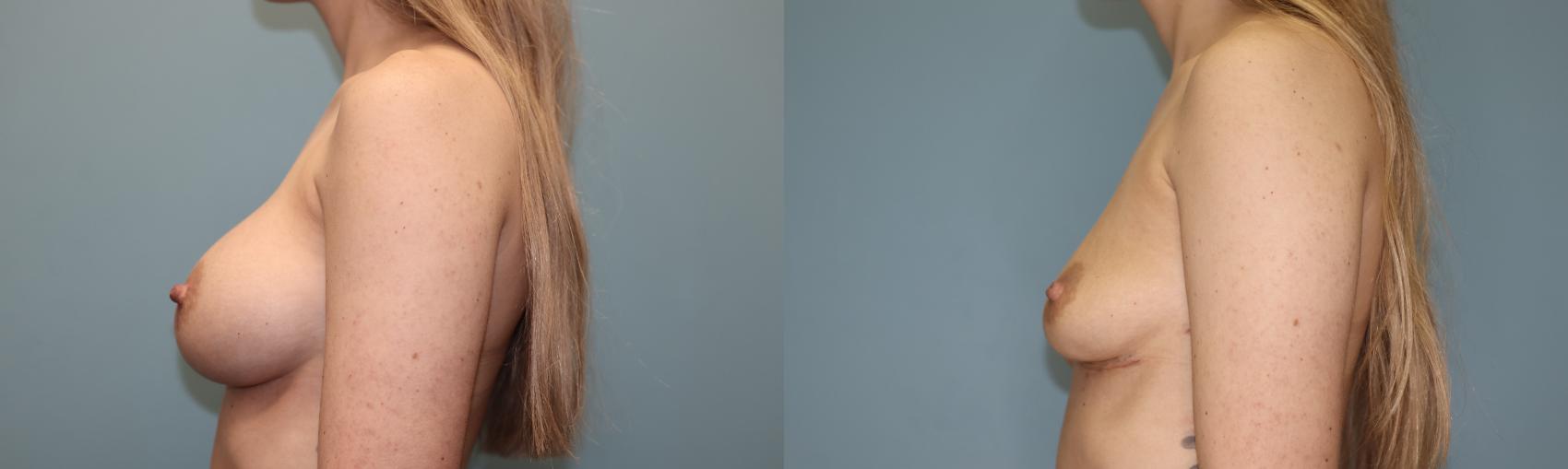 Before & After Breast Implant Removal with no Lift Case 45 Left Side View in Oklahoma City, Tulsa, Norman, OK