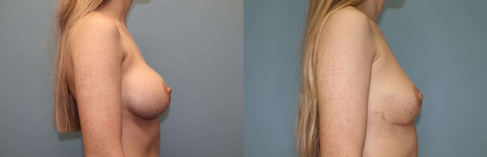 Before & After Breast Implant Removal with no Lift Case 45 Right Side View in Oklahoma City, Tulsa, Norman, OK