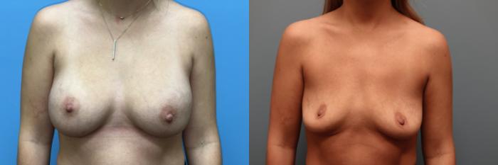 Before & After Breast Implant Removal with no Lift Case 46 Front View in Oklahoma City, Tulsa, Norman, OK