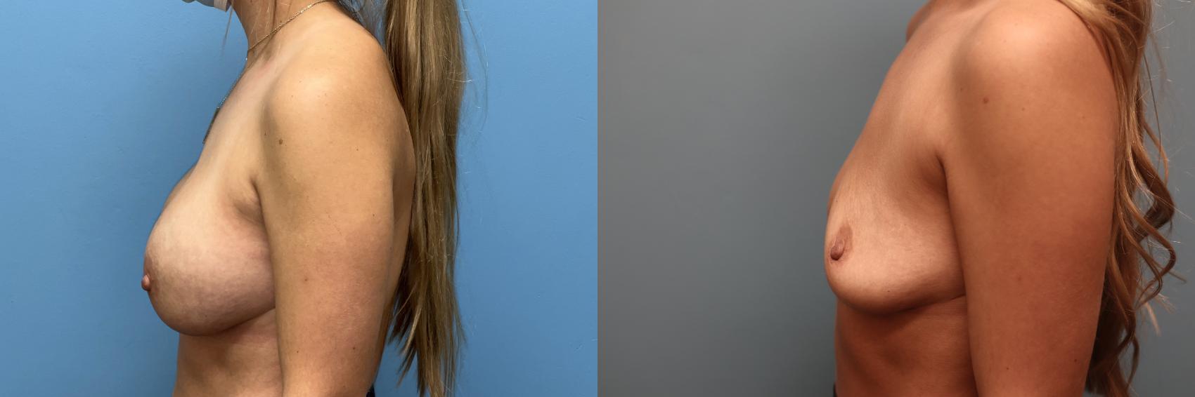 Before & After Breast Implant Removal with no Lift Case 46 Left Side View in Oklahoma City, Tulsa, Norman, OK