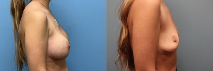 Before & After Breast Implant Removal with no Lift Case 46 Right Side View in Oklahoma City, Tulsa, Norman, OK