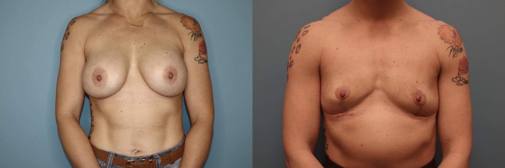 Before & After Breast Implant Removal with no Lift Case 47 Front View in Oklahoma City, Tulsa, Norman, OK