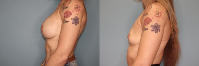 Before & After Breast Implant Removal with no Lift Case 47 Left Side View in Oklahoma City, Tulsa, Norman, OK