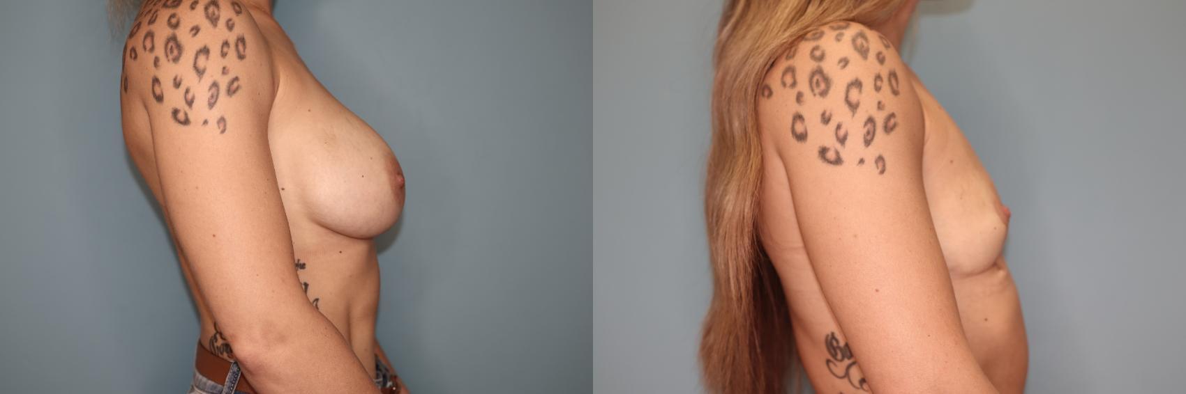 Before & After Breast Implant Removal with no Lift Case 47 Right Side View in Oklahoma City, Tulsa, Norman, OK