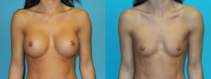 Before & After Breast Implant Removal with no Lift Case 48 Front View in Oklahoma City, Tulsa, Norman, OK