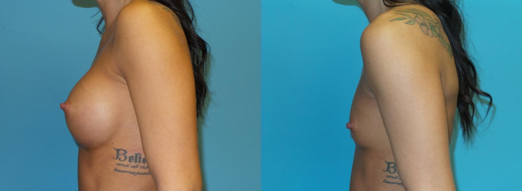 Before & After Breast Implant Removal with no Lift Case 48 Left Side View in Oklahoma City, Tulsa, Norman, OK