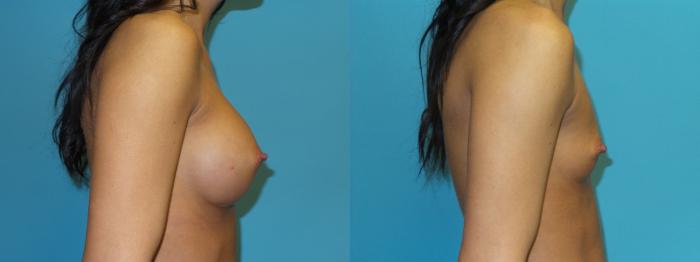 Before & After Breast Implant Removal with no Lift Case 48 Right Side View in Oklahoma City, Tulsa, Norman, OK