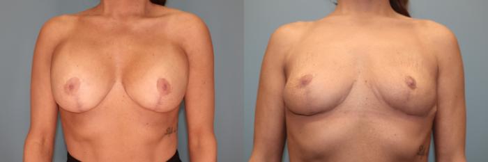 Before & After Breast Implant Removal with no Lift Case 49 Front View in Oklahoma City, Tulsa, Norman, OK