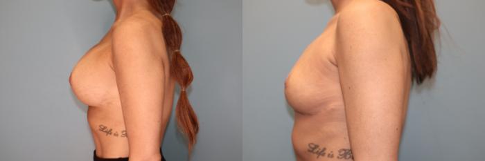 Before & After Breast Implant Removal with no Lift Case 49 Left Side View in Oklahoma City, Tulsa, Norman, OK