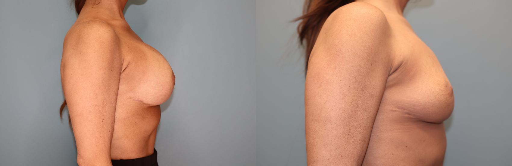 Before & After Breast Implant Removal with no Lift Case 49 Right Side View in Oklahoma City, Tulsa, Norman, OK