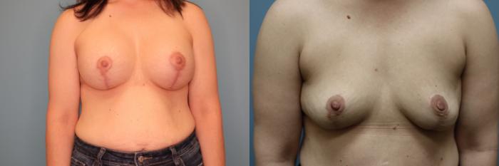 Before & After Breast Implant Removal with no Lift Case 50 Front View in Oklahoma City, Tulsa, Norman, OK
