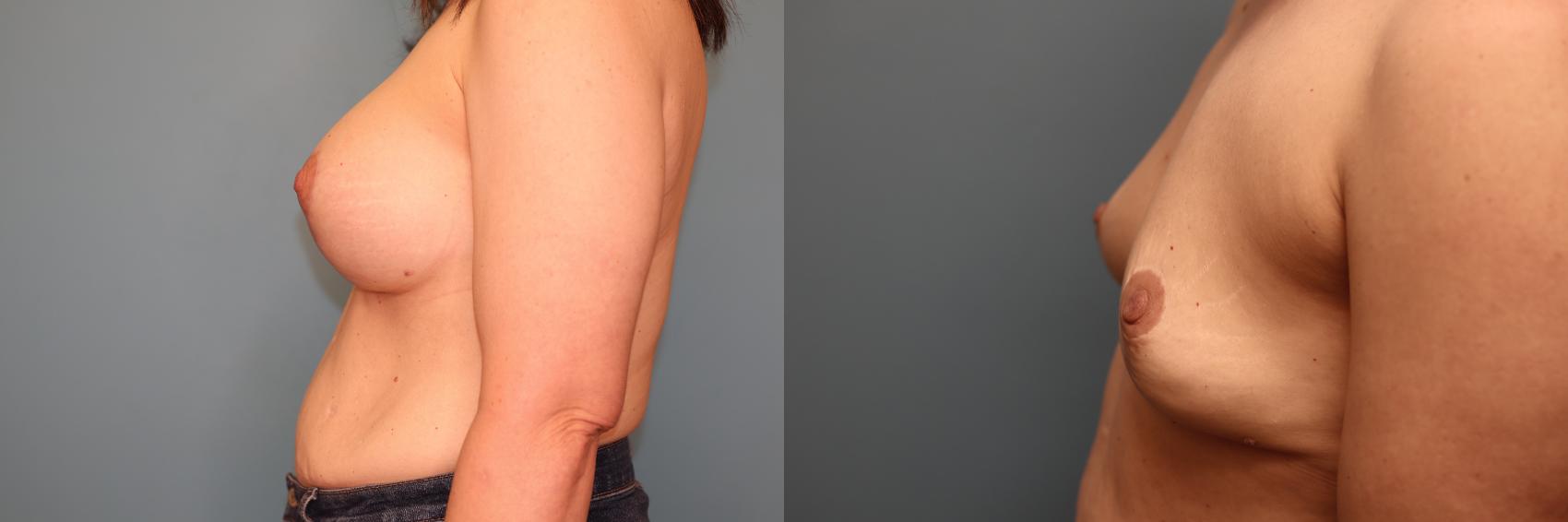 Before & After Breast Implant Removal with no Lift Case 50 Left Side View in Oklahoma City, Tulsa, Norman, OK