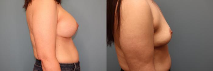 Before & After Breast Implant Removal with no Lift Case 50 Right Side View in Oklahoma City, Tulsa, Norman, OK