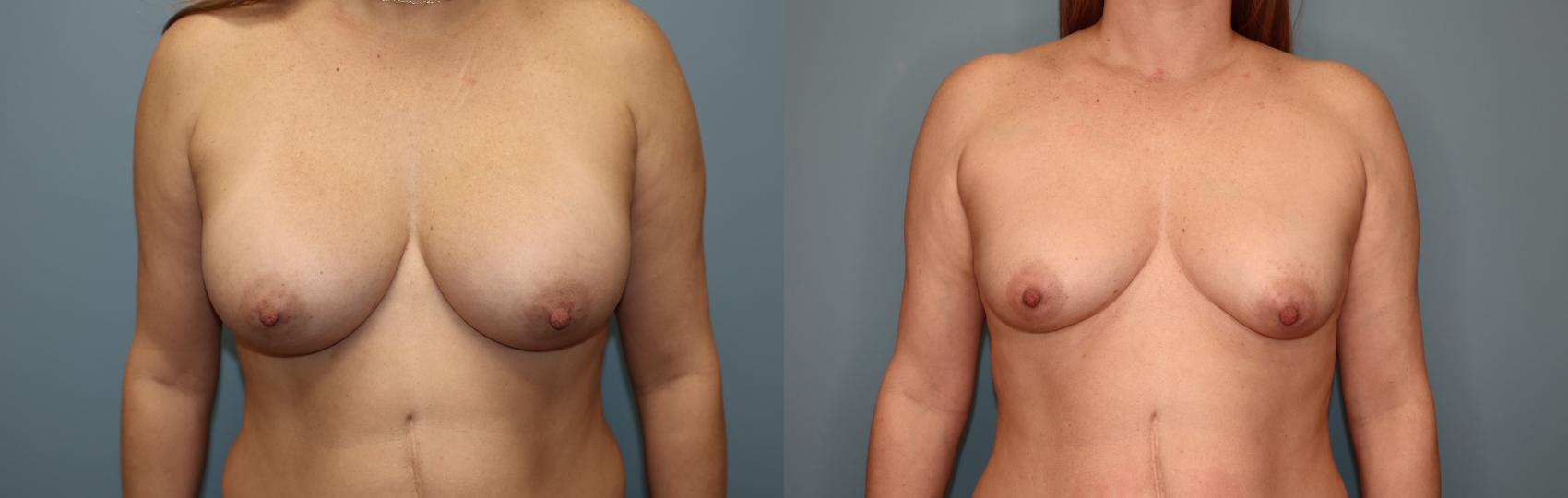Before & After Breast Implant Removal with no Lift Case 62 Front View in Oklahoma City, Tulsa, Norman, OK