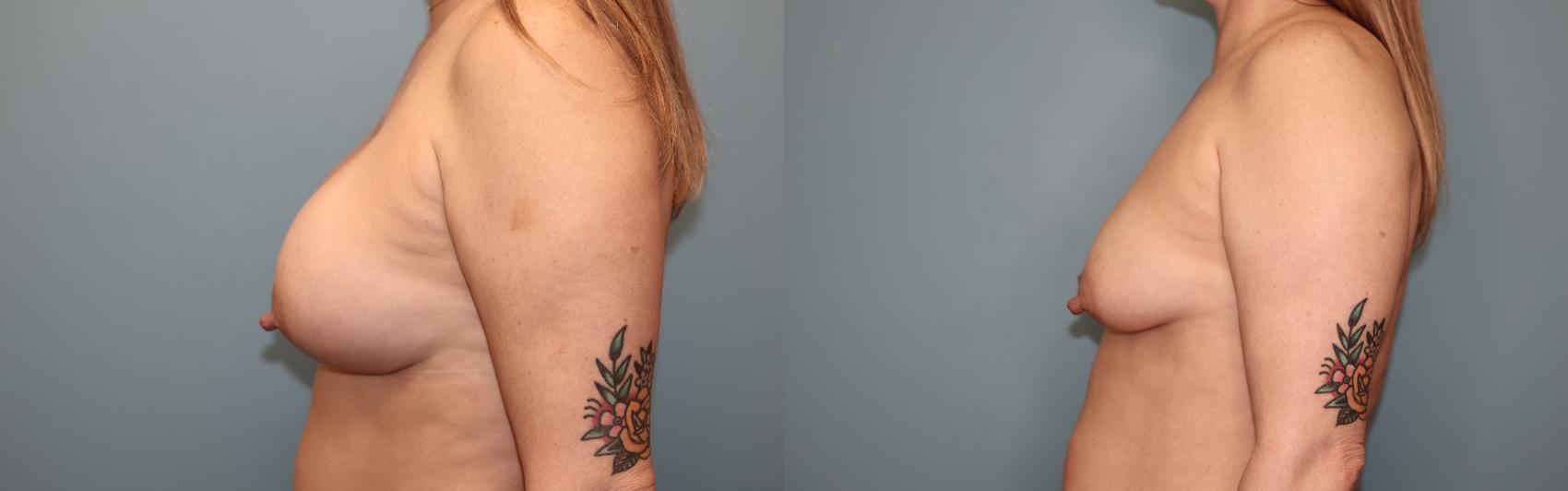 Before & After Breast Implant Removal with no Lift Case 62 Left Side View in Oklahoma City, Tulsa, Norman, OK