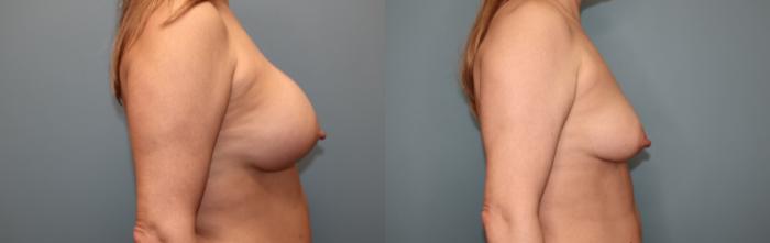 Before & After Breast Implant Removal with no Lift Case 62 Right Side View in Oklahoma City, Tulsa, Norman, OK