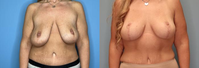 Before & After Breast Lift or Mastopexy  Case 77 Front View in Oklahoma City, Tulsa, Norman, OK