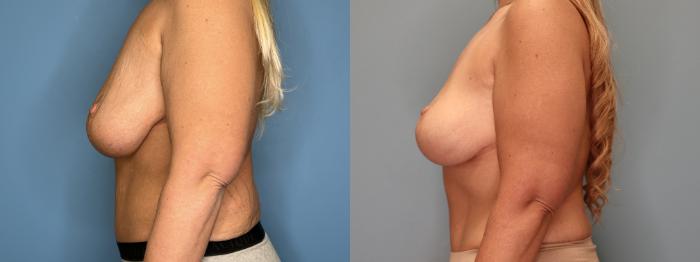 Before & After Breast Lift or Mastopexy  Case 77 Left Side View in Oklahoma City, Tulsa, Norman, OK