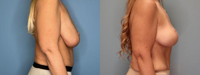 Before & After Breast Lift or Mastopexy  Case 77 Right Side View in Oklahoma City, Tulsa, Norman, OK