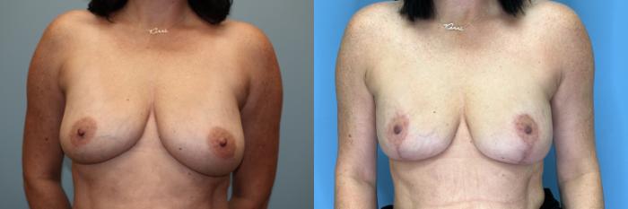 Before & After Breast Lift or Mastopexy  Case 78 Front View in Oklahoma City, Tulsa, Norman, OK