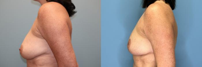 Before & After Breast Lift or Mastopexy  Case 78 Left Side View in Oklahoma City, Tulsa, Norman, OK