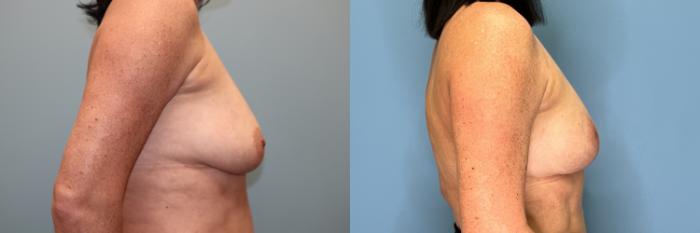 Before & After Breast Lift or Mastopexy  Case 78 Right Side View in Oklahoma City, Tulsa, Norman, OK