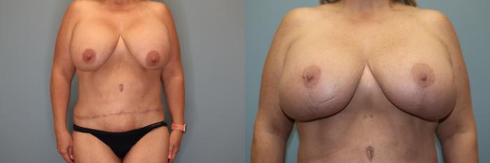 Before & After Breast Lift or Mastopexy  Case 79 Front View in Oklahoma City, Tulsa, Norman, OK
