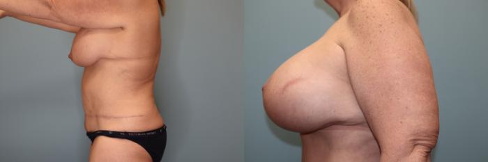 Before & After Breast Lift or Mastopexy  Case 79 Left Side View in Oklahoma City, Tulsa, Norman, OK