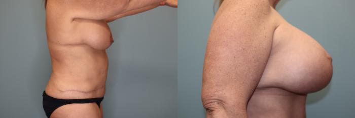 Before & After Breast Lift or Mastopexy  Case 79 Right Side View in Oklahoma City, Tulsa, Norman, OK