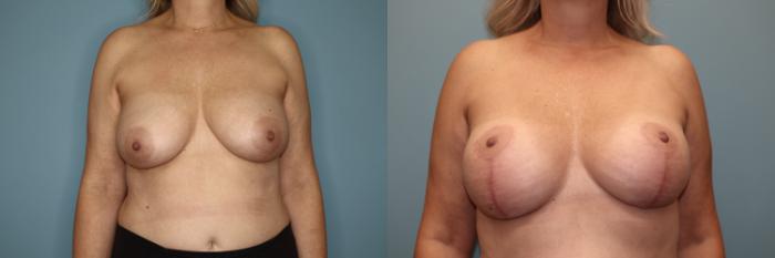 Before & After Breast Lift or Mastopexy  Case 80 Front View in Oklahoma City, Tulsa, Norman, OK