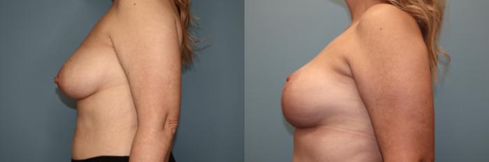 Before & After Breast Lift or Mastopexy  Case 80 Left Side View in Oklahoma City, Tulsa, Norman, OK