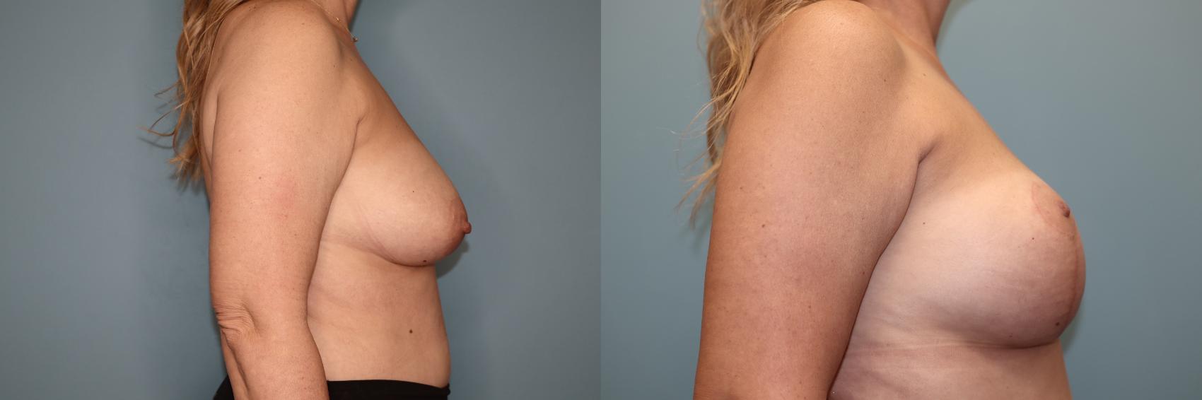 Before & After Breast Lift or Mastopexy  Case 80 Right Side View in Oklahoma City, Tulsa, Norman, OK