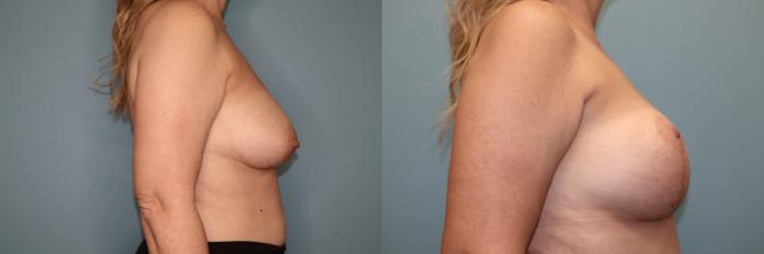 Before & After Breast Lift or Mastopexy  Case 80 Right Side View in Oklahoma City, Tulsa, Norman, OK