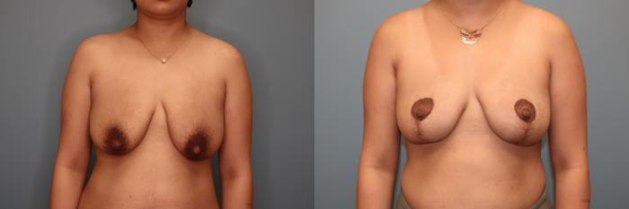 Before & After Breast Lift or Mastopexy  Case 81 Front View in Oklahoma City, Tulsa, Norman, OK