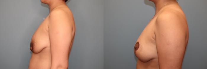 Before & After Breast Lift or Mastopexy  Case 81 Left Side View in Oklahoma City, Tulsa, Norman, OK