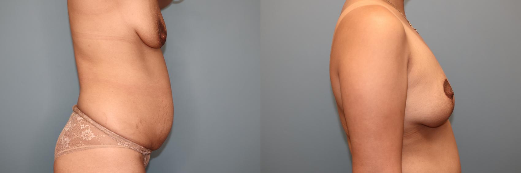 Before & After Breast Lift or Mastopexy  Case 81 Right Side View in Oklahoma City, Tulsa, Norman, OK