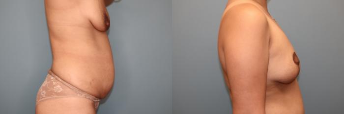 Before & After Breast Lift or Mastopexy  Case 81 Right Side View in Oklahoma City, Tulsa, Norman, OK