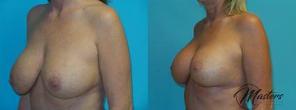 Before & After Breast Lift with Implant Case 21 Left Oblique View in Oklahoma City, Tulsa, Norman, OK