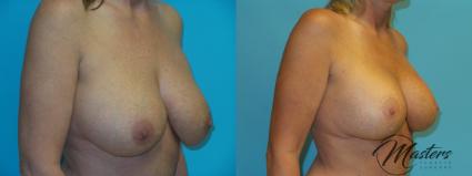 Before & After Breast Lift with Implant Case 21 Right Oblique View in Oklahoma City, Tulsa, Norman, OK