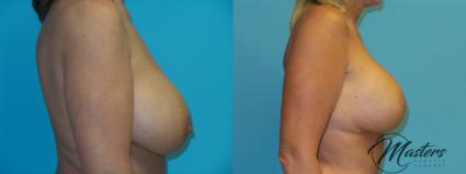 Before & After Breast Lift with Implant Case 21 Right Side View in Oklahoma City, Tulsa, Norman, OK