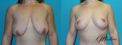 Before & After Breast Lift with Implant Case 7 Front View in Oklahoma City, Tulsa, Norman, OK