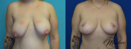 Before & After Breast Lift with Implant Case 8 Front View in Oklahoma City, Tulsa, Norman, OK
