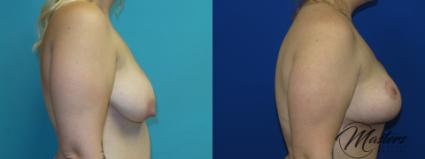 Before & After Breast Lift with Implant Case 8 Right Side View in Oklahoma City, Tulsa, Norman, OK
