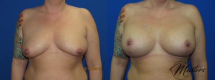 Before & After Breast Lift with Implant Case 9 Front View in Oklahoma City, Tulsa, Norman, OK