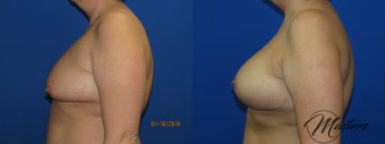 Before & After Breast Lift with Implant Case 9 Left Side View in Oklahoma City, Tulsa, Norman, OK