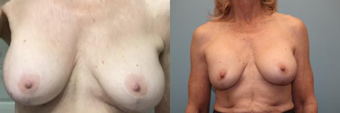 Before & After Capsulotomy and Capsulectomy  Case 39 Front View in Oklahoma City, Tulsa, Norman, OK
